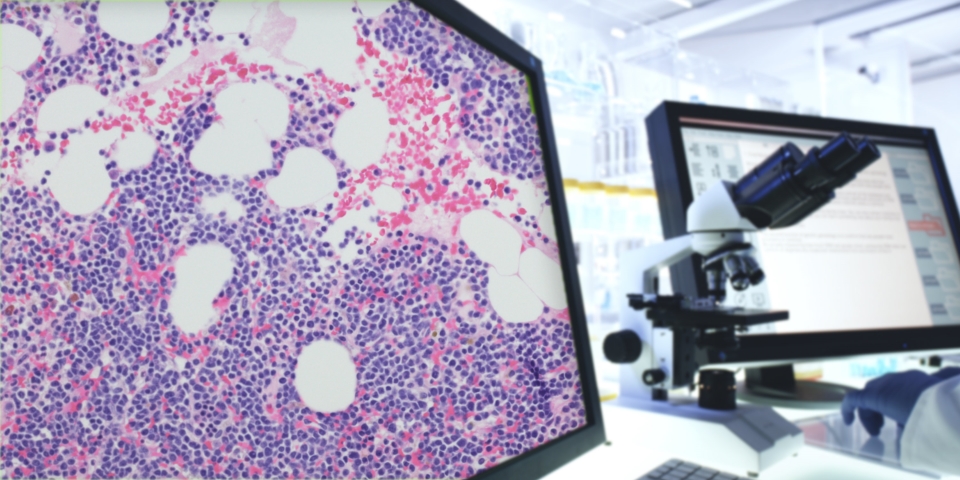 myeloma on a screen in medical lab